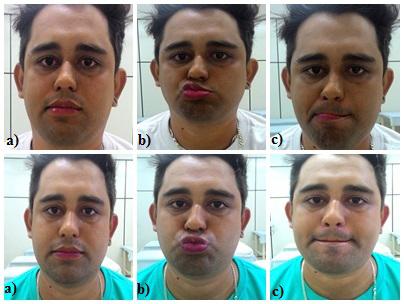 Acupuntura com base nas ramificações do nervo facial 5 Figura 6: Comparativo da mímica facial antes e após a técnica de acupuntura. a) Repouso; b) Fazer Bico; c) Projeção Labial.