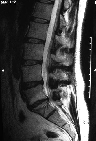 No Grupo MIS, houve a necessidade de converter, no início da curva de aprendizado, parcialmente para cirurgia aberta em dois pacientes, um hematoma perirradicular com radiculite inflamatória