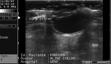 Ultra-Sonografia Oftálmica em Cães com Catarata Figura 7: Imagem ultra-sonográfica da Sub-luxação um poodle com 7 anos de idade. A imagem é correspondente deslocamento da lente de sua posição normal.