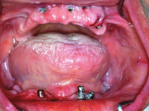 ARTIGOS CIENTÍFICOS Kawakami PY, Romeiro R de L INTRODUÇÃO A implantodontia moderna revolucionou as opções terapêuticas em odontologia.