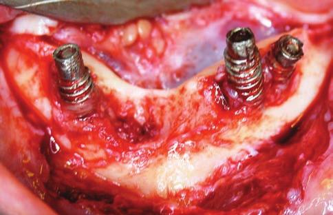 Figura 6 - Implantes zigomáticos instalados.