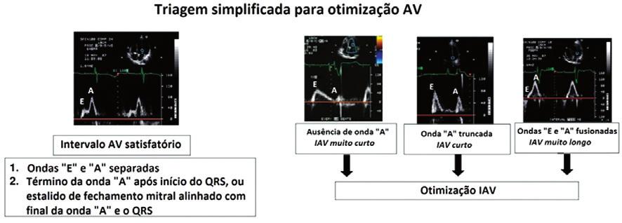 Otimização do marcapasso na ressincronização cardíaca: importância da ecocardiografia após o esforço, com discreto aumento da FC, e comparado às medidas no repouso em posição sentada ou supina 29.