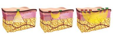 TECNOLOGIA 3DEEP Radiofrequência multi-canais com controle de fase; Aprovada pelo FDA,