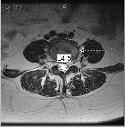 THE AIMS OF MISS GET THE TARGET (DISEASE) S PI WITH MINIMAL N EAGRESSION TO