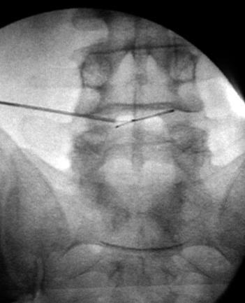 navegação intradiscal com catéter lesão