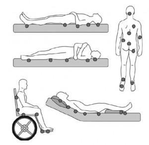 5 Figura 3: Locais mais acometidos Fonte: Seat Mobile do Brasil Além de medidas preventivas, como por exemplo, o cuidado da pele e o reposicionamento no leito, existem recursos fisioterapêuticos para