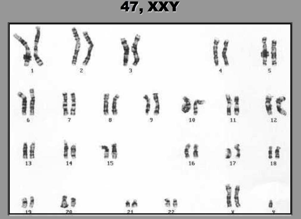 c) As síndromes caracterizadas por progéria ocorrem pela rápida degradação dos centrômeros dos cromossomos autossomos de pacientes acometidos.