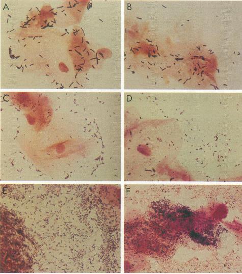 18 FIGURA 2: Padrões de microbiota vaginal em esfregaços corados por Gram observados sob objetiva de imersão (x1000).