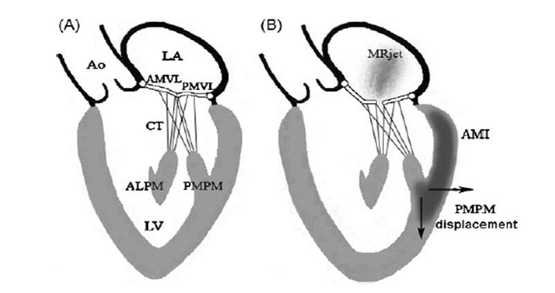 Figura 2: Mecanismos da Rmi crónica. (A) Válvula mitral normal: os folhetos valvulares coaptam ao nível do anel valvular.