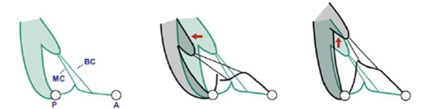 A B C Figura 3 Padrões de tethering dos folhetos. A) Coaptação normal dos folhetos; B) Tethering assimétrico; C) Tethering simétrico. (Adapatado de: Jeffrey J. Silbiger.