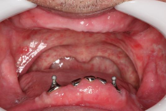 se que o paciente apresentava edentulismo total de maxila e usava uma prótese total mucossuportada.