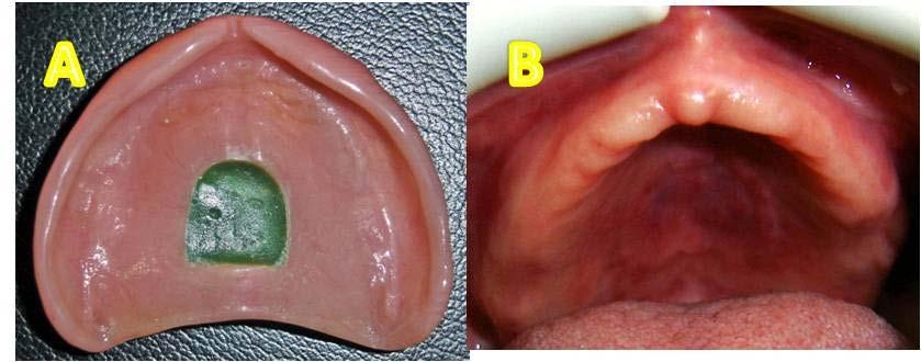 cuja coloração pode se apresentar semelhante à da mucosa adjacente e que tem um crescimento lento, e geralmente, assintomático7.