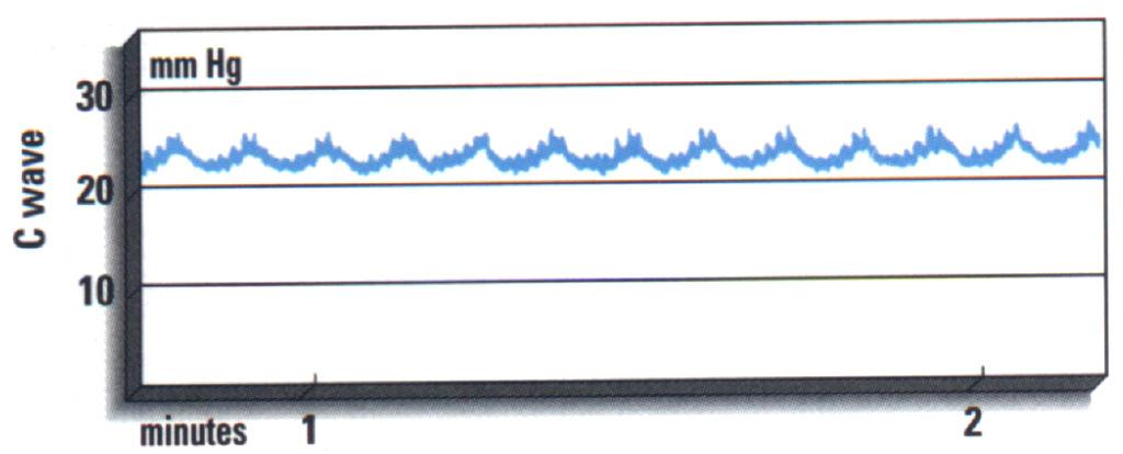 ultrapassam os 50 mmhg atribuem-se a PPC limite e variações da PaCO 2.