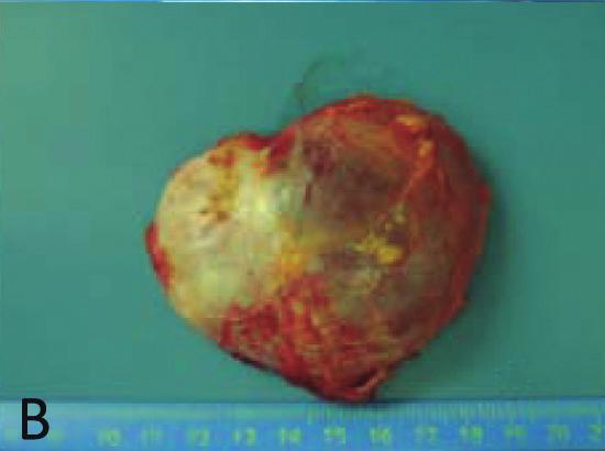 Tumores de baixo potencial maligno ou tumores proliferativos atípicos de ovário Anteriormente classificados como borderline (termo não recomendado pela FIGO International Federation of Gynecology and