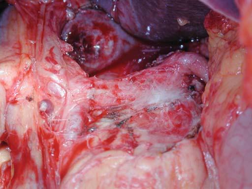 Figura 3: Isolamento do tumor das estruturas vasculares e orgânicas, sem complicações Figura 4: Tumor excisado, com 6 cm de maior comprimento tuberculosis complex.