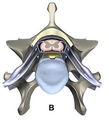 1 Figura 3 A) Desenho esquemático de um corte normal da região entre a quinta (C5) e a sexta vértebras cervicais (C6) de um cão