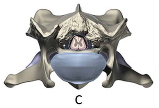 B) Compressão ventral na região de C5-C6 decorrente da protrusão do disco intervertebral e hipertrofia do ligamento amarelo e