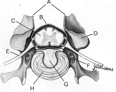 a) Local da laminectomia; b) Dura-máter c) Medula espinhal; d) Processo Articular; e) Raiz do Nervo Espinhal f) Veias vertebrais; g) Extrusão do núcleo pulposo; h) Ânulo fibroso.