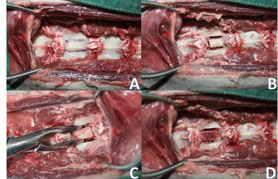 55 Figura 1- Aspecto transoperatório do procedimento de corpectomia cervical na quinta vértebra cervical. A) Delimitação dos limites laterais do defeito a ser realizado.