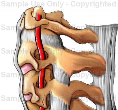 Coluna Cervical Inferior Os processos transversos de C3 a C6 apresentam forames transversos pelos quais passa a artéria vertebral que irriga uma parte do encéfalo.