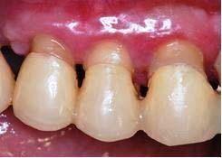 19 4 CASO CLÍNICO Paciente de 64 anos, sexo masculino, apresentou-se no curso de Especialização em Prótese Dentária da FOUFMG, para tratamento de Reabilitação Oral.