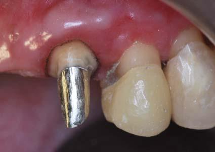 1): Dentes Tempo de repreparo envolvidos pós cirurgia 15 45 dias (6 semanas) Nível gengival do repreparo No nível Creeping