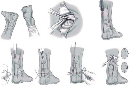 Foi feita uma incisão com aproximadamente 2cm de extensão, posicionada medial à linha média posterior da perna e 3cm do coto proximal do tendão (Figuras 1 e 2).