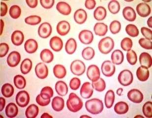 Ocorre nas talassemias (tal maior ou anemia de Cooley e tal menor), em pacientes com hemoglobinopatias (doença da Hb CC, anemia falciforme,