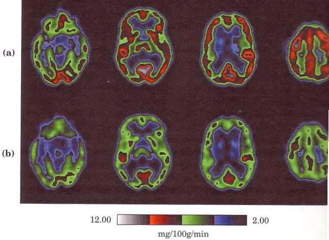 TRANSMISSÃO DO IMPULSO ELÉTRICO PELO CÉREBRO Figura 36. Metabolismo da glicose no cérebro.