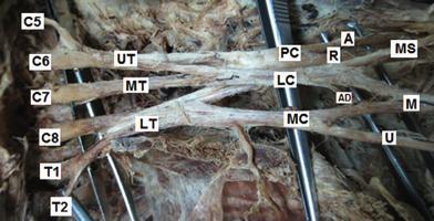 Figura 6. Dissecção cadavérica mostrando um plexo braquial pós-fixo proveniente do ramo ventral de C5 a T2. From Guday E, Bekele A, Muche A.