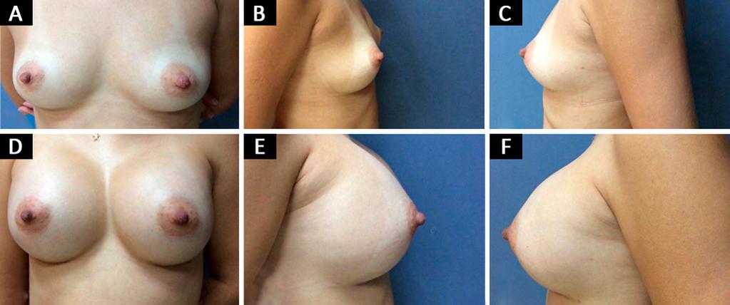 0,6% Figura 11. Caso 4. A, B e C: Período pré-operatório; D, E e F: Período pósoperatório de 24 meses. Tabela 4. Complicações peculiares à mamoplastia de aumento.