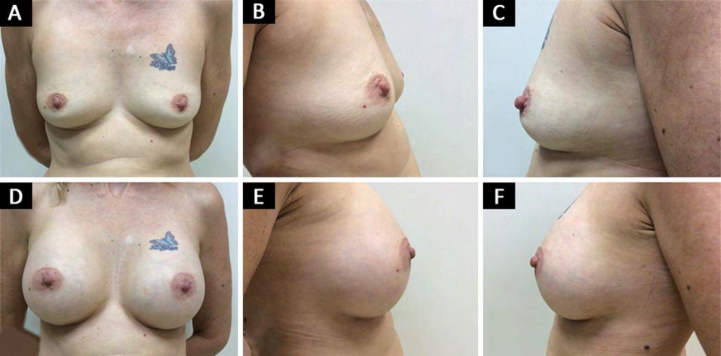 Das complicações peculiares à mamoplastia de aumento, tivemos os seguintes percentuais, que estão na Tabela 4.