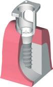 5.a TOMA DE IMPRESSÕES SNAP-ON Para implante de ombro Ø 4,8 mm RN Para implante de ombro Ø 6,5 mm WN N.º art. 048.