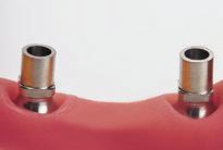 2. Restauração com pilares synocta para provisórios (para RN e WN) Ombro de implante Ø 4,8 mm RN Ombro de implante Ø 6,5 mm WN N art. 048.