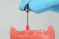 Coloque o pilar PLAN no implante (utilização intraoral) ou análogo de implante (utilização extraoral).