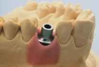 Na área do ombro, os cilindros têm uma altura de 4,5 mm e um diâmetro de 8,0 mm ou 10,0 mm e podem ser desgastados individualmente para obter um perfil de emergência ideal (forma anatómica do ombro