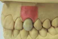 C) Colocação do trabalho definitivo A entrega ao dentista é feita com o pilar original sobre o modelo.