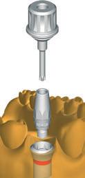 10.b synocta CIMENTADO Pilares para coroas e pontes cimentadas Ombro de implante de Ø 4,8 mm RN N.º art. 048.