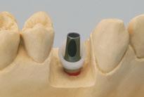 3a 3b 3c Importante: Antes da entrega do trabalho ao dentista, devem ser novamente removidas as vedações lateral e oclusal das aberturas de parafuso, e o pilar deve ser limpo. 3. A seguir, moldagem e fundição da estrutura.