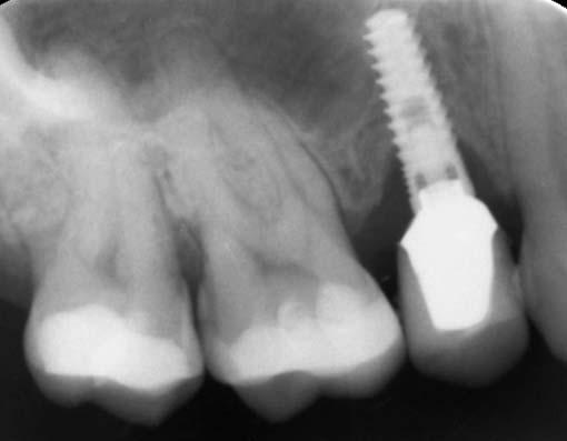 90 A raspagem de implantes durante a terapia de suporte com curetas e pontas de ultrassom de plástico ou teflon permite a instrumentação eficiente das roscas expostas sem danos à superfície.