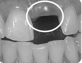 dentários. Internet: <http://centralparkperio.com>. Na imagem precedente, a parte coronal e o parafuso de proteção do implante podem ser vistos por transparência através da gengiva.