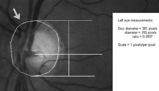 Hemorragia peripapilar em pacientes com glaucoma e sua relação com o tronco vascular retiniano 561 do em uma posição deslocada superiormente ao longo do diâmetro vertical do disco óptico.