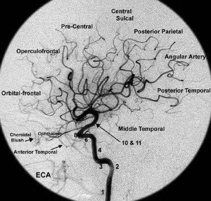 Coroidéia anterior Art.