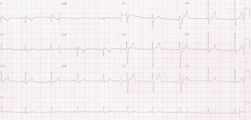 ABC do ECG Caso 2 L.T.S.