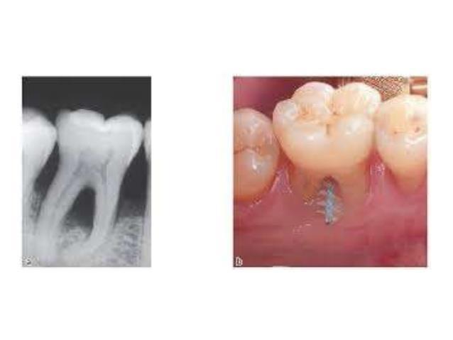 INSTRUMENTAIS PARA PERIODONTIA: