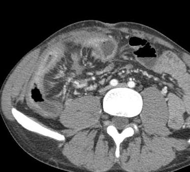 Aplicação e diagnóstico Doença de Crohn espessamento e