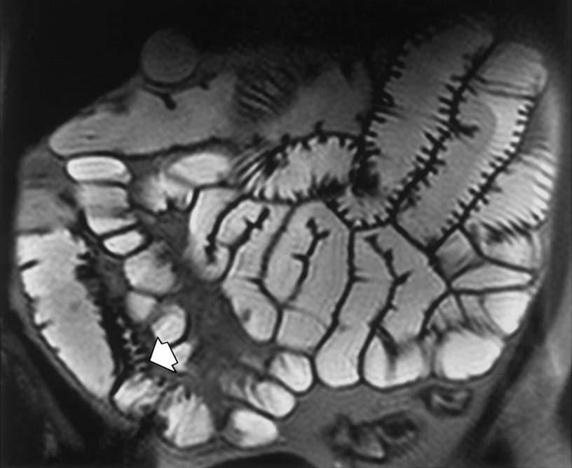MR Imaging of the small bowel
