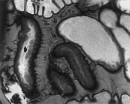 RM-E exemplos Crohn Panos