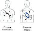 Bifásica: conforme recomendações do fabricante (120 a 200J) desconhecida usar máxima disponível BIFÁSICA: a corrente é liberada em uma direção e, após uma pequena pausa, reverte-se em direção oposta