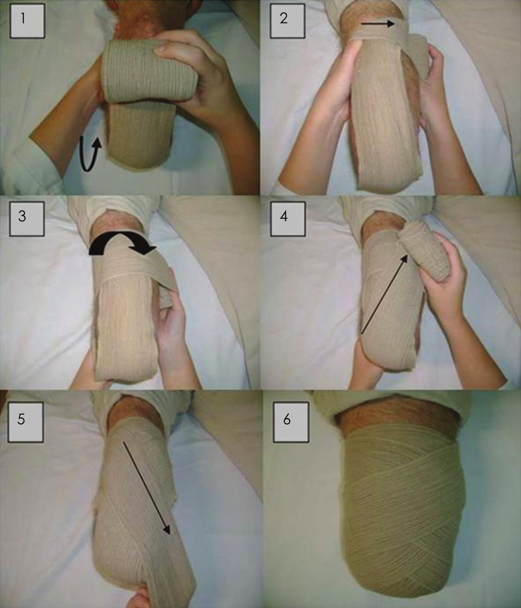 Figuras 1 a 6. Técnica adequada de enfaixamento do coto transtibial Quadro 2.